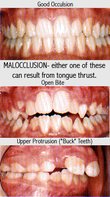 Tongue Thrust Example Photo